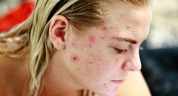 Woman with acne marks